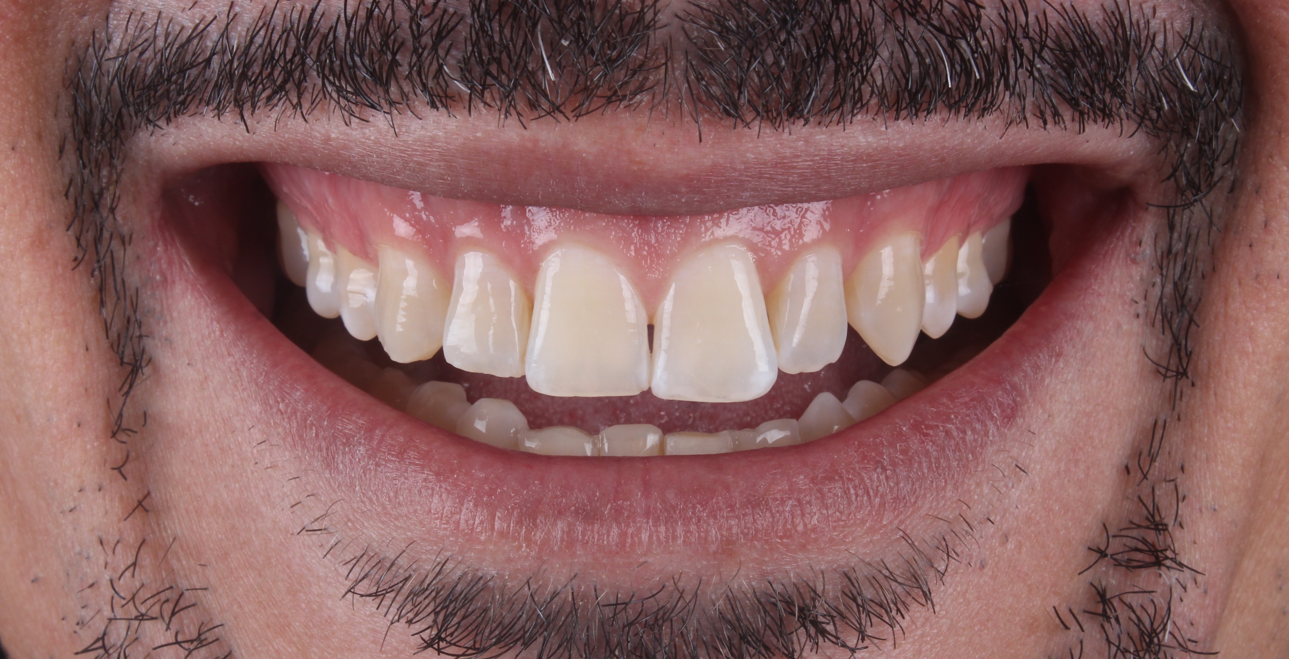 Antes das facetas de resina